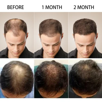 PURC Karstā pārdošanas Ātru Matu Augšanu Būtība Eļļa Matu Izkrišana Ārstēšana Palīdzēs matu Augšanu Matu Kopšana Dabīgās sastāvdaļas remonts