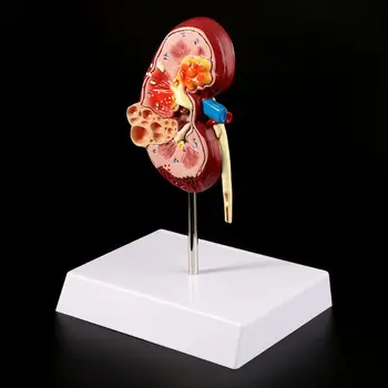 2019 JAUNU Dzīves Izmēra Cilvēka Nieres Slimo Modelis Anatomijas Anatomija Slimo Patoloģiskas Akmens Orgānu Mācību materiāli