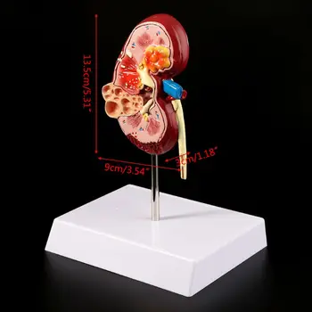 2019 JAUNU Dzīves Izmēra Cilvēka Nieres Slimo Modelis Anatomijas Anatomija Slimo Patoloģiskas Akmens Orgānu Mācību materiāli